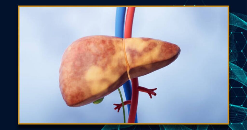 Las complicaciones del hígado graso y la importancia de su detección temprana