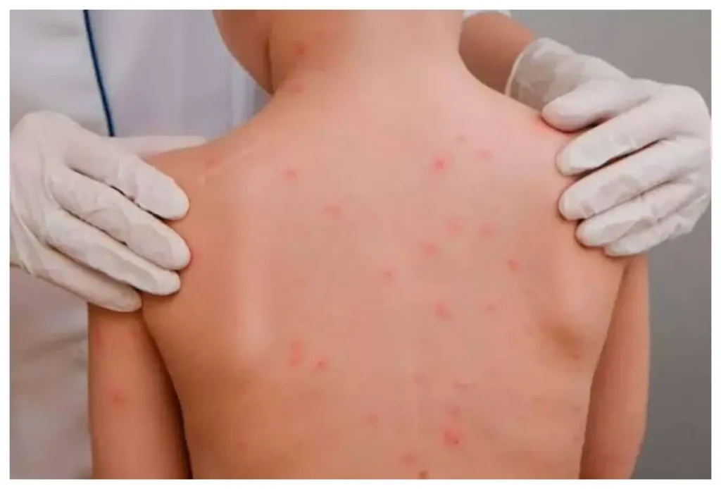 Tercer caso de sarampión detectado en Bahía de Banderas: intensifican vacunación en domicilios